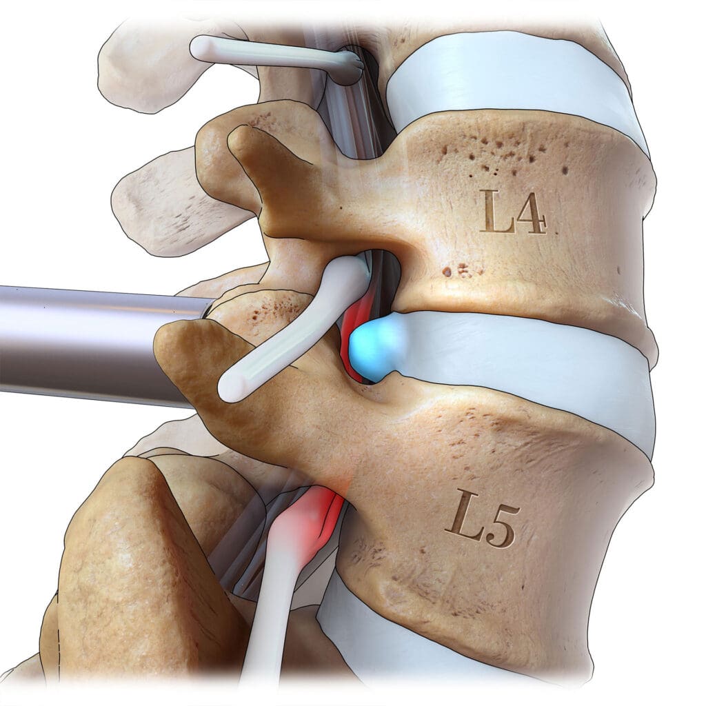 Lumbar Microdiscectomy