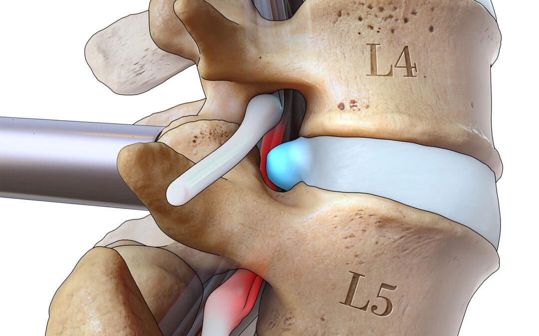 Lumbar Microdiscectomy