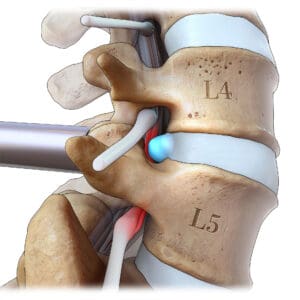 Lumbar Microdiscectomy